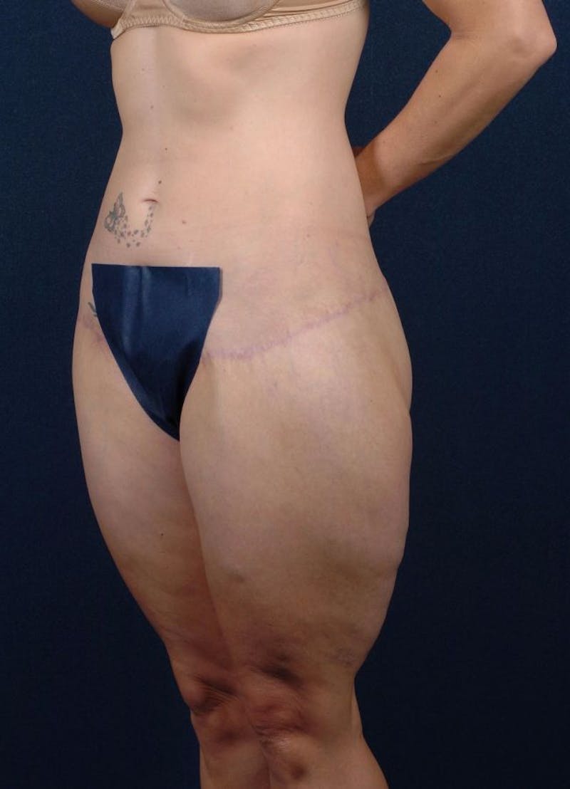 Female Liposuction Gallery - Patient 9421708 - Image 4