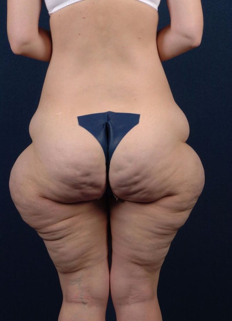 Female Liposuction Gallery - Patient 9421708 - Image 5