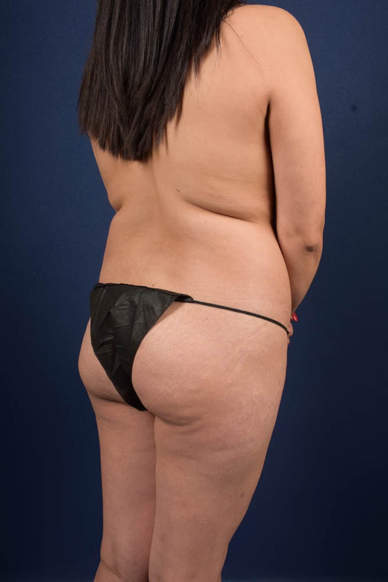 Brazilian Buttock Lift Before & After Gallery - Patient 9421713 - Image 5