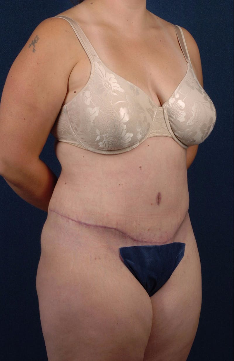 Extreme Body Contouring Before & After Gallery - Patient 9421711 - Image 6