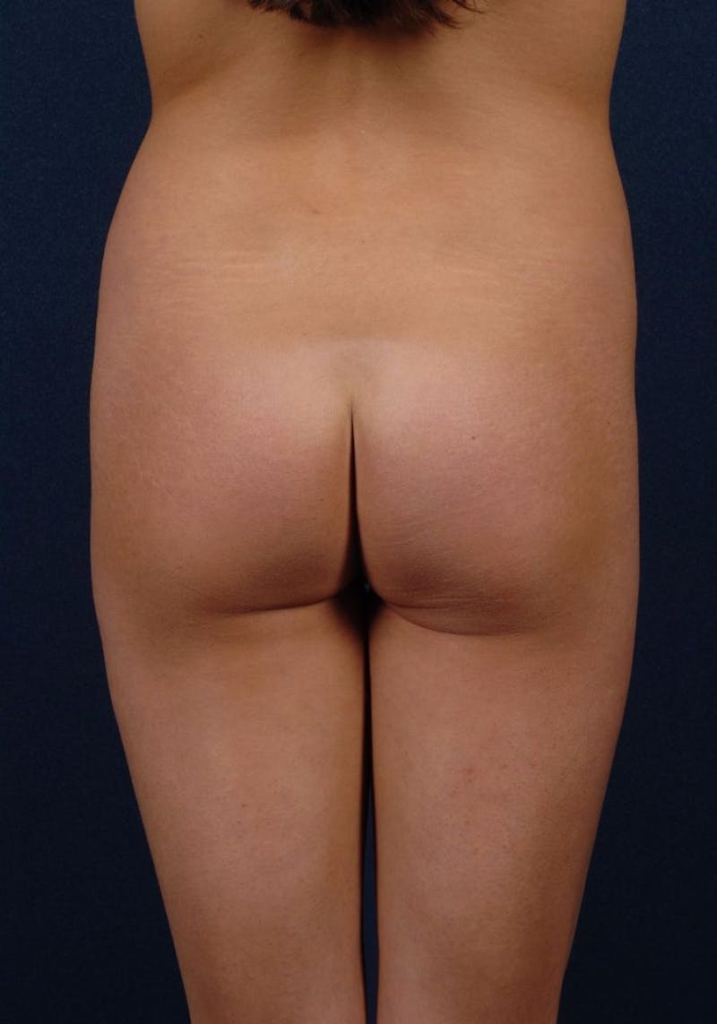 Gluteal Augmentation Before & After Gallery - Patient 9421715 - Image 1