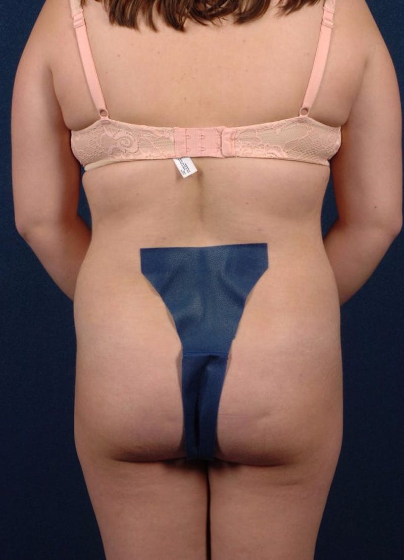 Female Liposuction Gallery - Patient 9421714 - Image 2