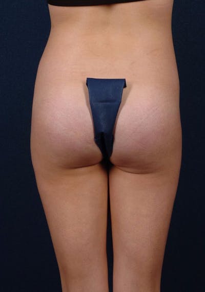 Gluteal Augmentation Before & After Gallery - Patient 9421715 - Image 2