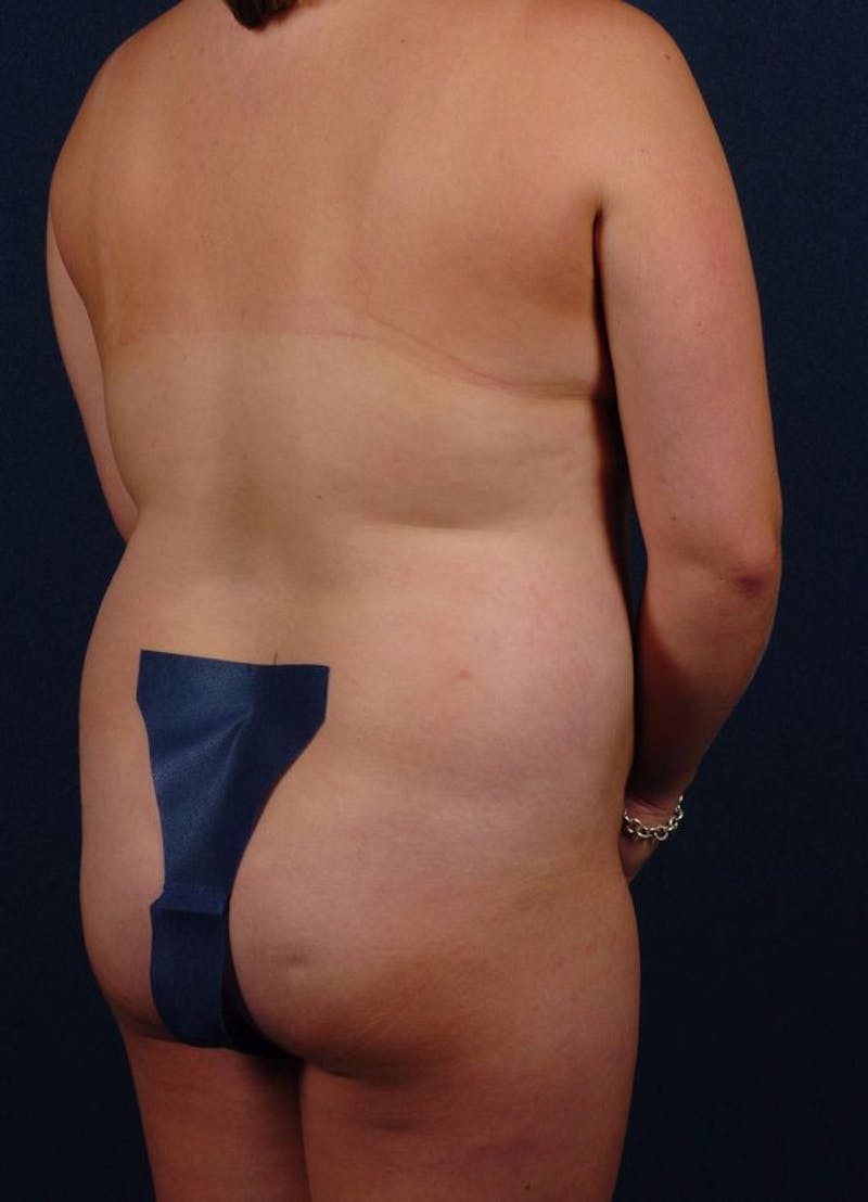 Female Liposuction Before & After Gallery - Patient 9421714 - Image 3