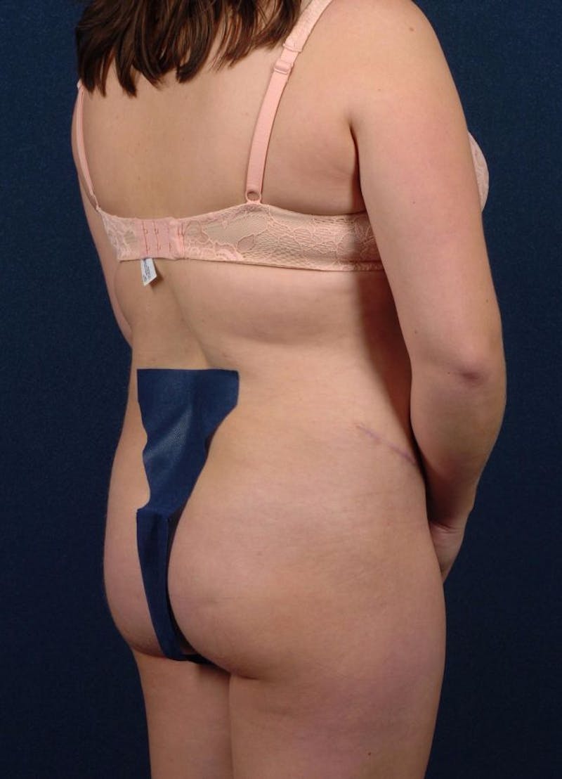 Female Liposuction Gallery - Patient 9421714 - Image 4