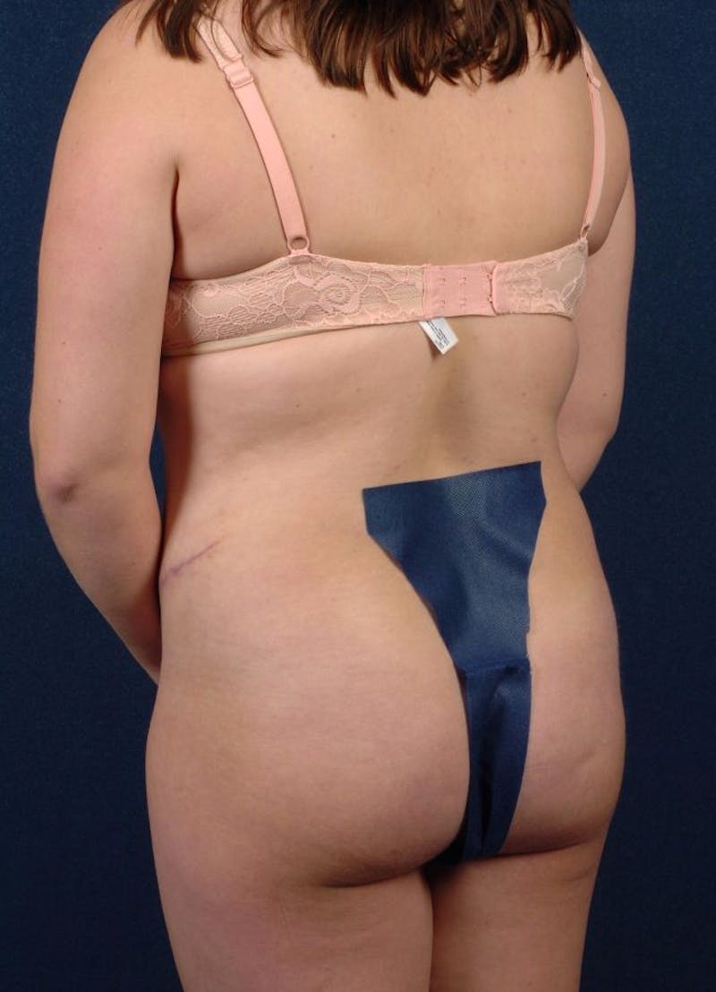 Female Liposuction Gallery - Patient 9421714 - Image 6