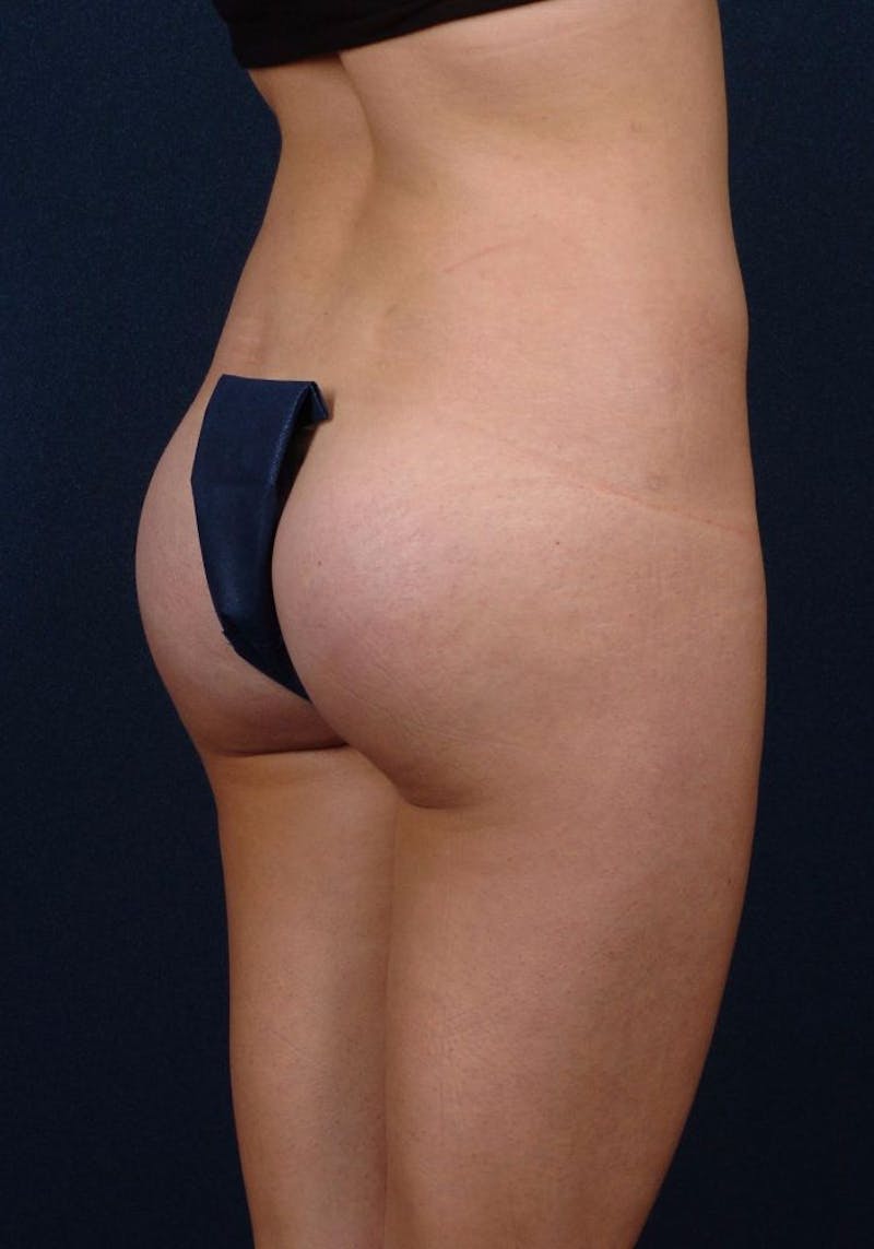 Gluteal Augmentation Before & After Gallery - Patient 9421715 - Image 6