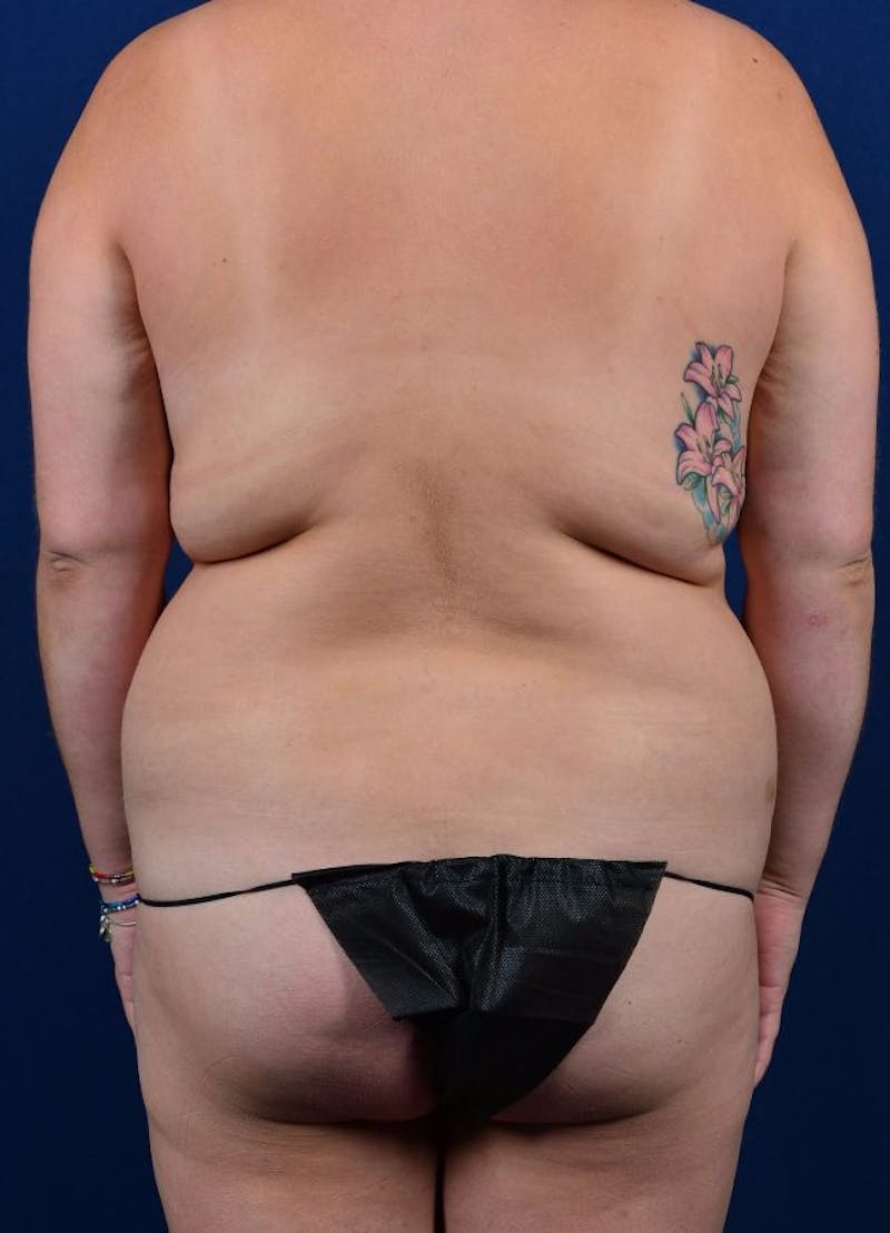 Female Liposuction Before & After Gallery - Patient 9421717 - Image 1