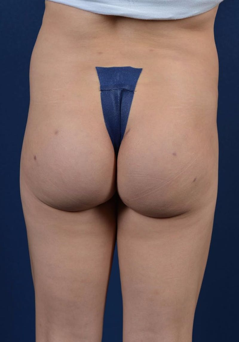 Gluteal Augmentation Before & After Gallery - Patient 9421719 - Image 2