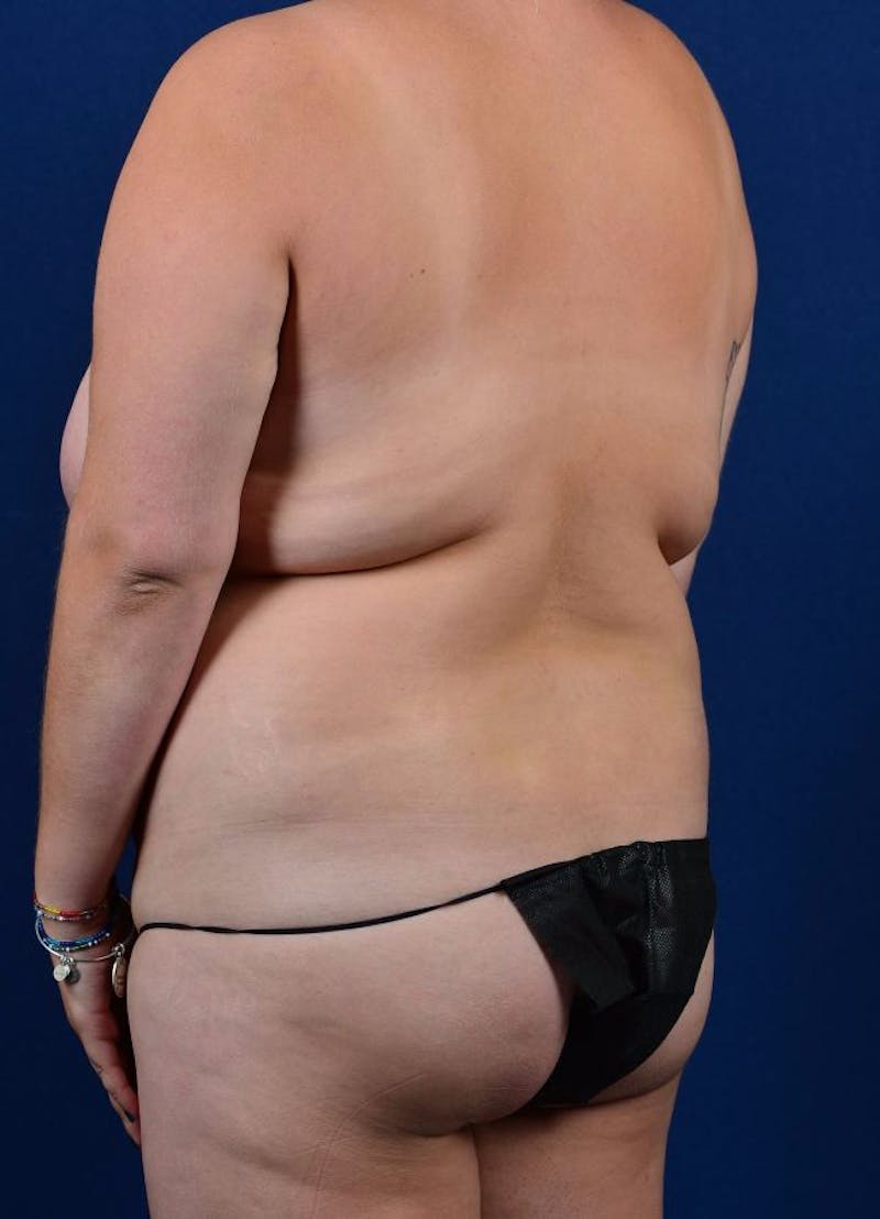 Female Liposuction Before & After Gallery - Patient 9421717 - Image 3