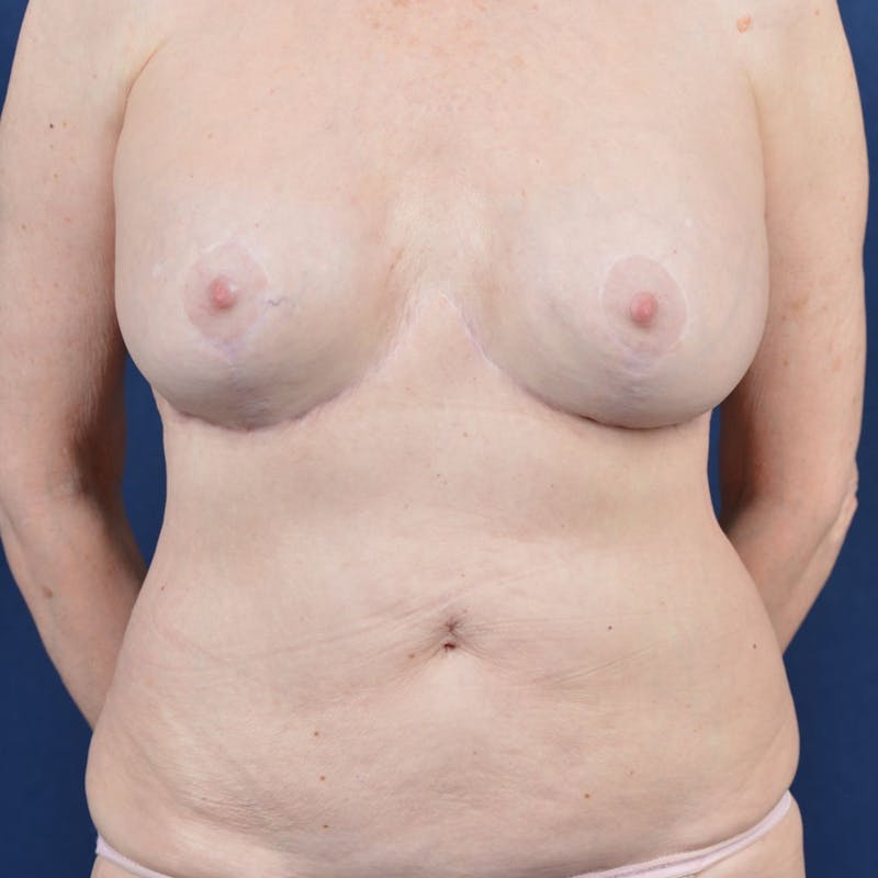 Extreme Body Contouring Before & After Gallery - Patient 9421718 - Image 2