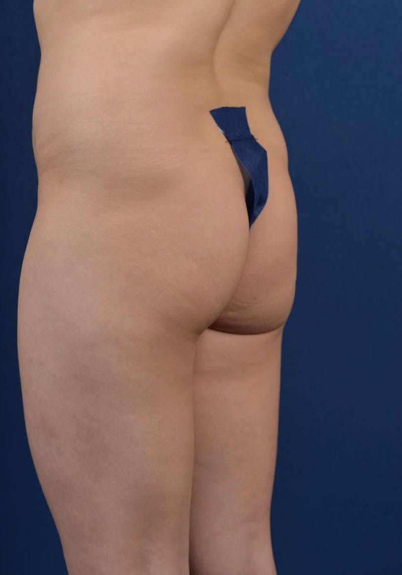 Gluteal Augmentation Before & After Gallery - Patient 9421719 - Image 3