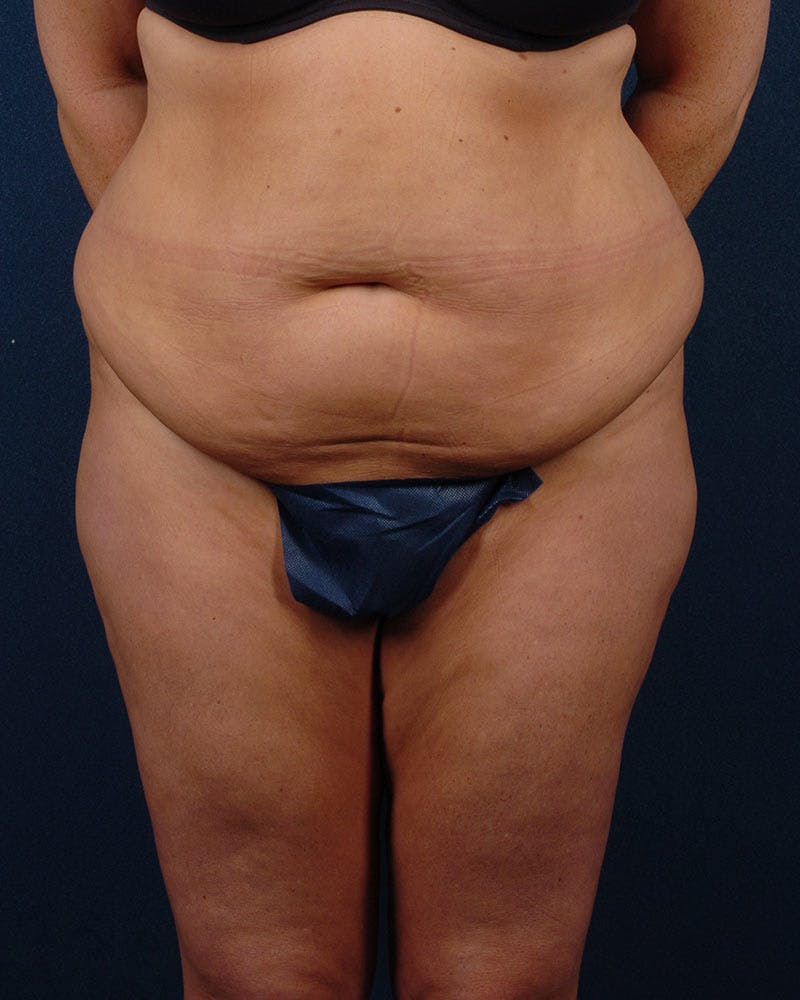 Extreme Body Contouring Before & After Gallery - Patient 9421730 - Image 1
