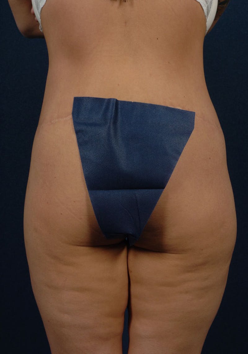 Gluteal Augmentation Gallery - Patient 9421724 - Image 1