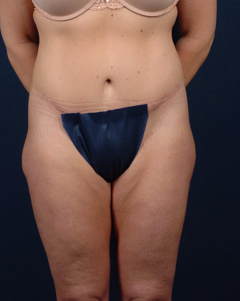 Extreme Body Contouring Before & After Gallery - Patient 9421730 - Image 2