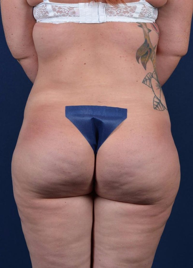 Female Liposuction Before & After Gallery - Patient 9421723 - Image 2