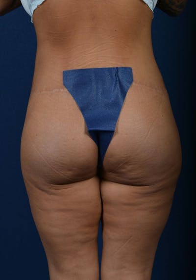 Gluteal Augmentation Before & After Gallery - Patient 9421724 - Image 2