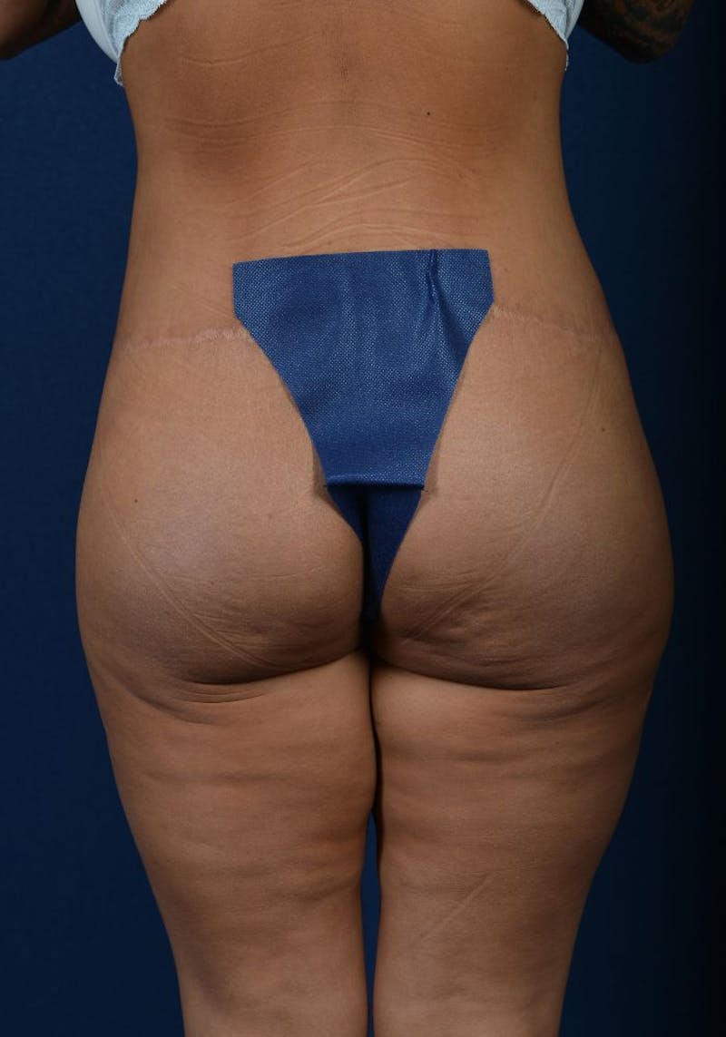 Gluteal Augmentation Before & After Gallery - Patient 9421724 - Image 2