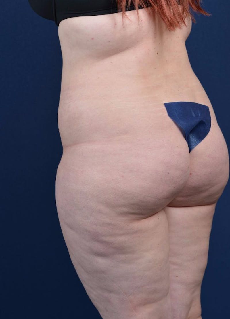 Female Liposuction Before & After Gallery - Patient 9421723 - Image 3