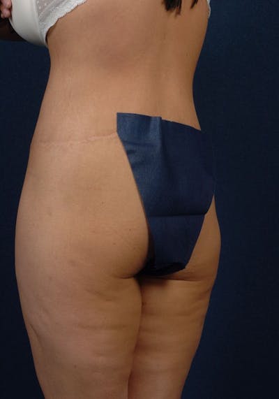 Gluteal Augmentation Before & After Gallery - Patient 9421724 - Image 3