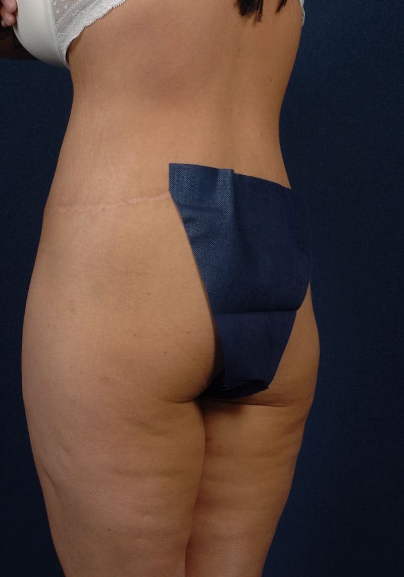 Gluteal Augmentation Gallery - Patient 9421724 - Image 3