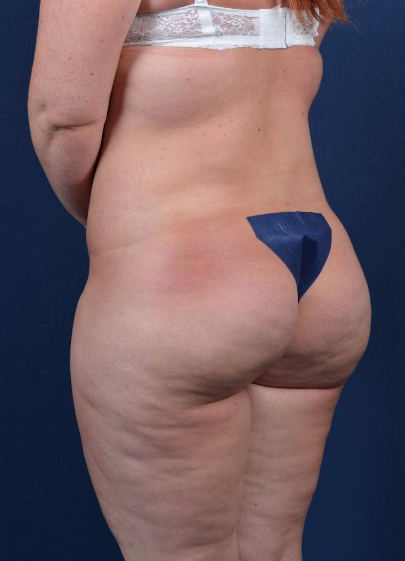 Female Liposuction Before & After Gallery - Patient 9421723 - Image 4