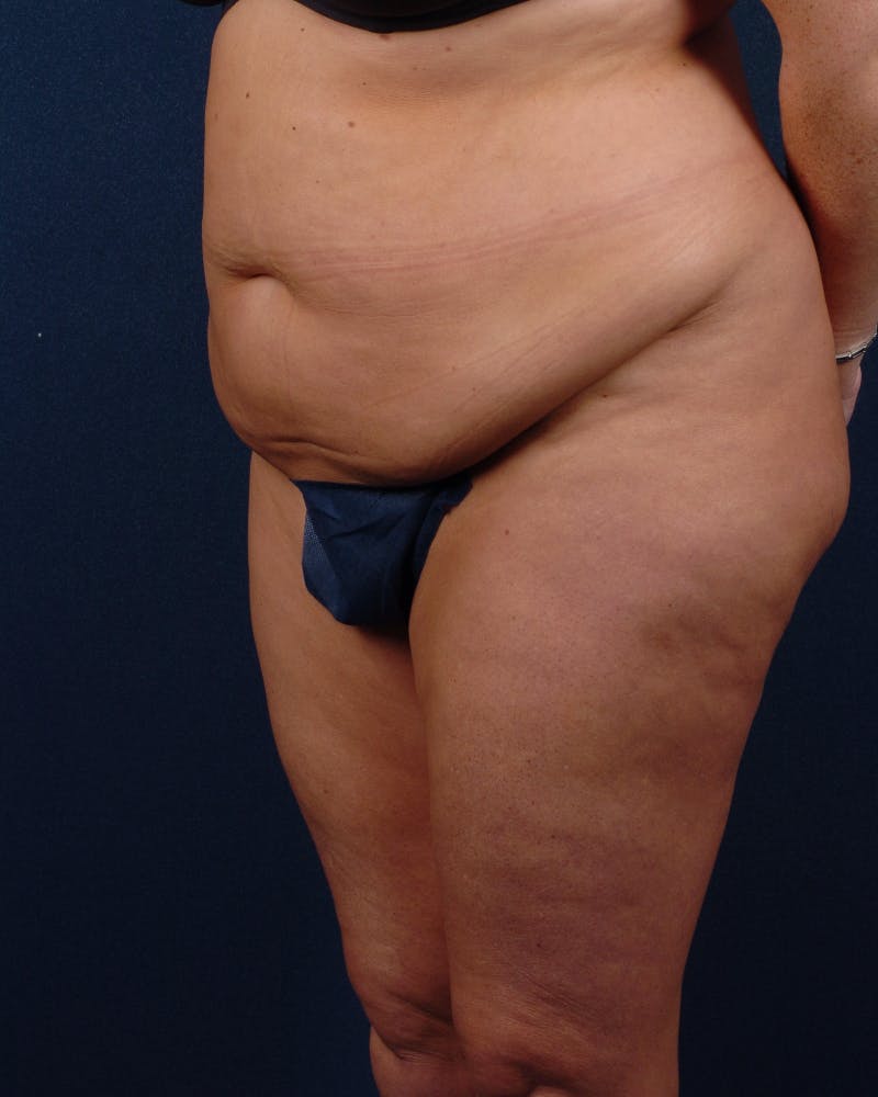 Extreme Body Contouring Gallery - Patient 9421730 - Image 3