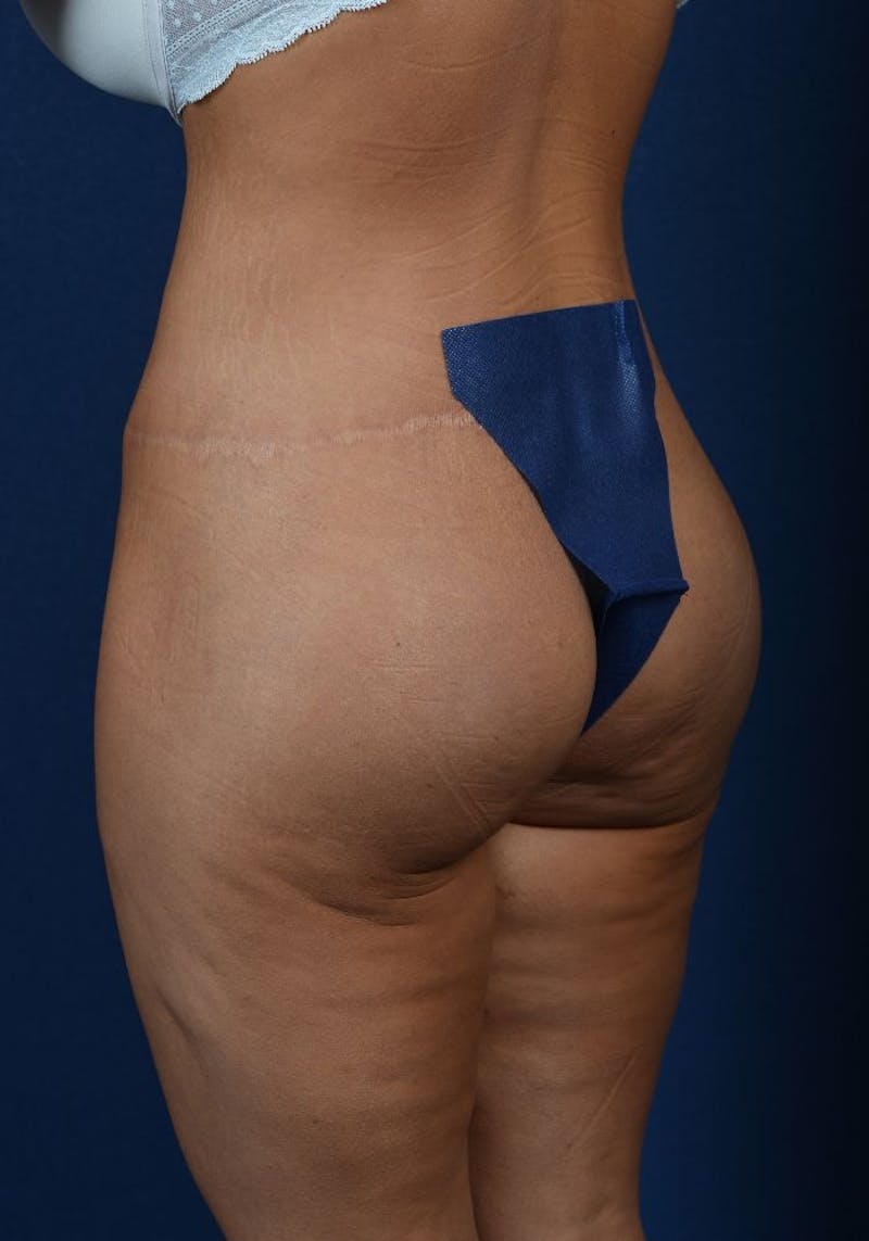Gluteal Augmentation Before & After Gallery - Patient 9421724 - Image 4