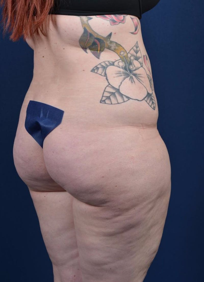 Female Liposuction Before & After Gallery - Patient 9421723 - Image 5