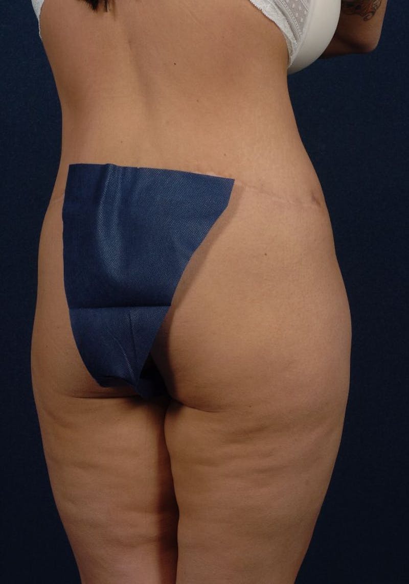 Gluteal Augmentation Before & After Gallery - Patient 9421724 - Image 5