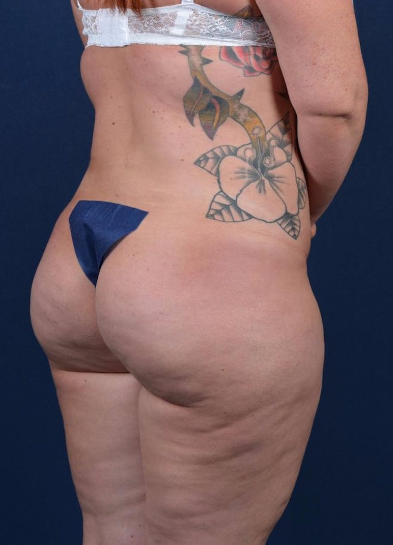 Female Liposuction Gallery - Patient 9421723 - Image 6