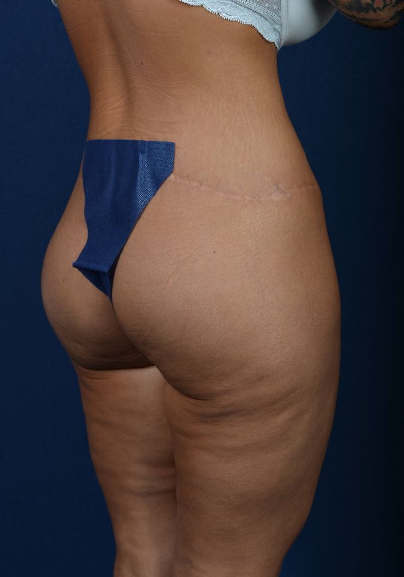 Gluteal Augmentation Before & After Gallery - Patient 9421724 - Image 6