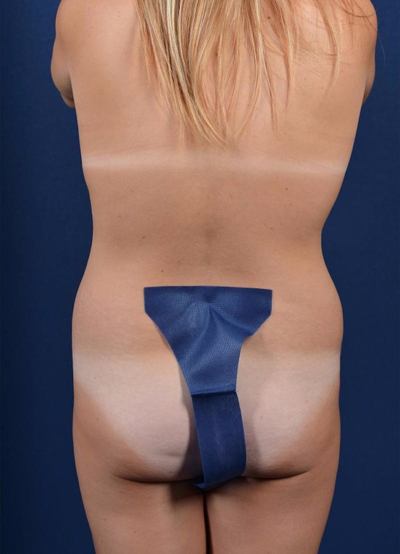 Female Liposuction Before & After Gallery - Patient 9421728 - Image 1
