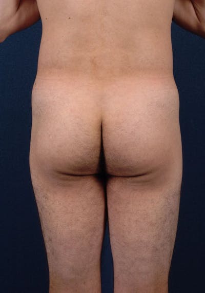 Gluteal Augmentation Before & After Gallery - Patient 9421726 - Image 1