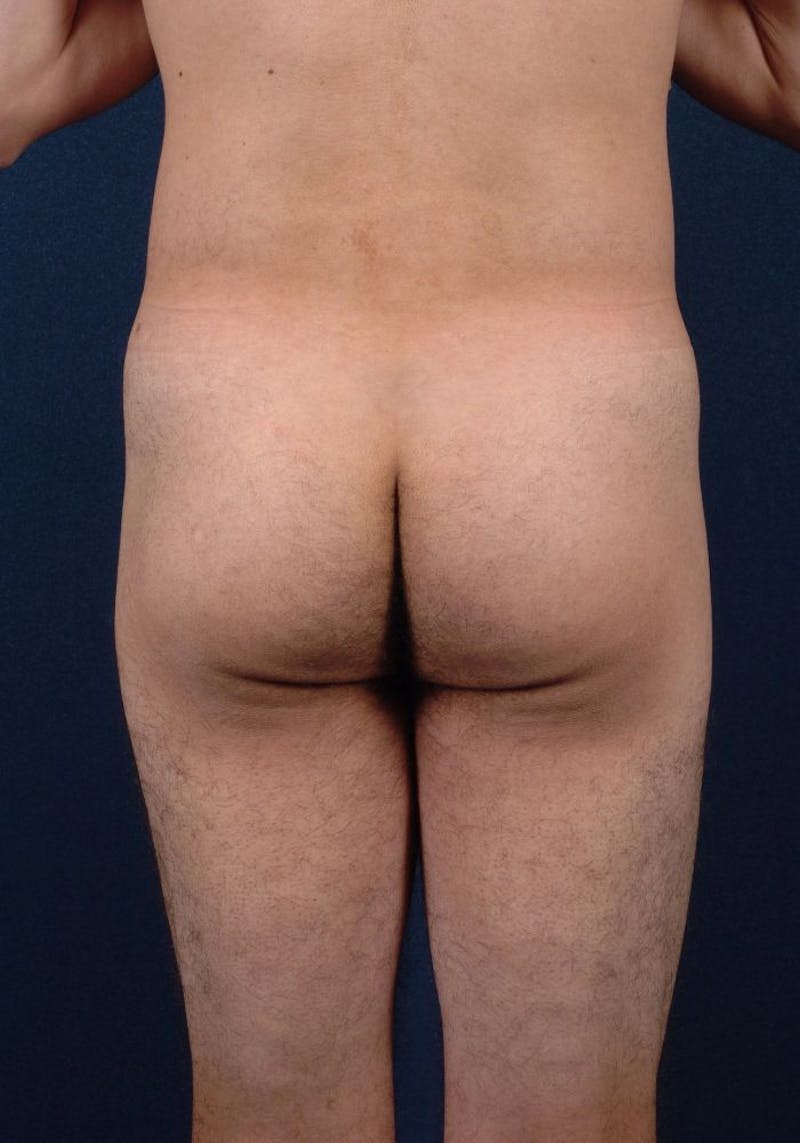 Gluteal Augmentation Before & After Gallery - Patient 9421726 - Image 1