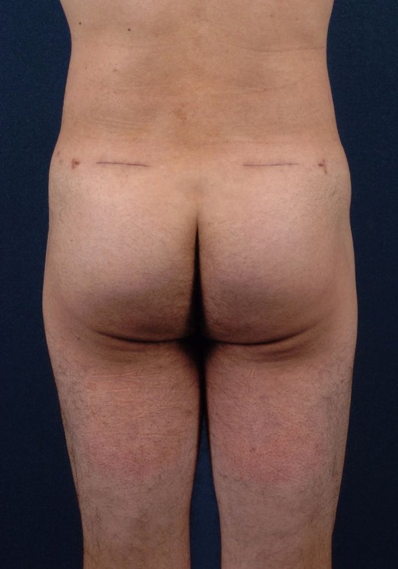Gluteal Augmentation Before & After Gallery - Patient 9421726 - Image 2