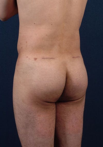 Gluteal Augmentation Before & After Gallery - Patient 9421726 - Image 4