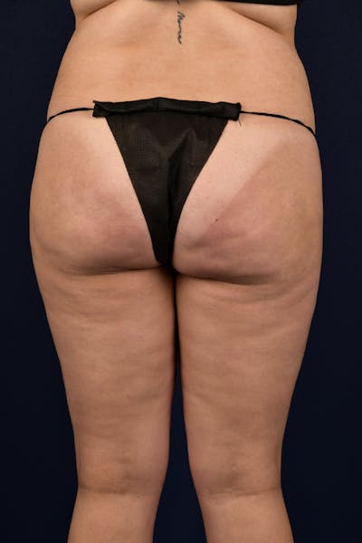 Brazilian Buttock Lift Before & After Gallery - Patient 9421729 - Image 1
