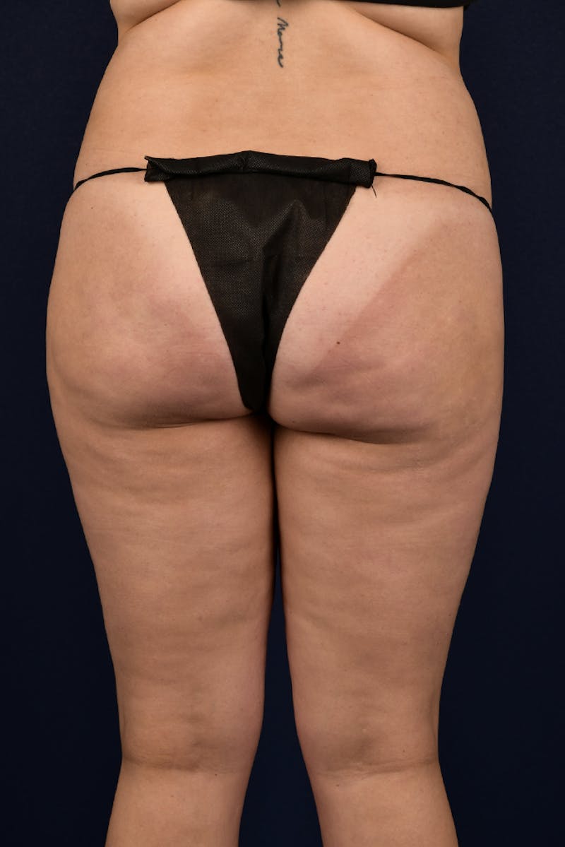 Brazilian Buttock Lift Before & After Gallery - Patient 9421729 - Image 1
