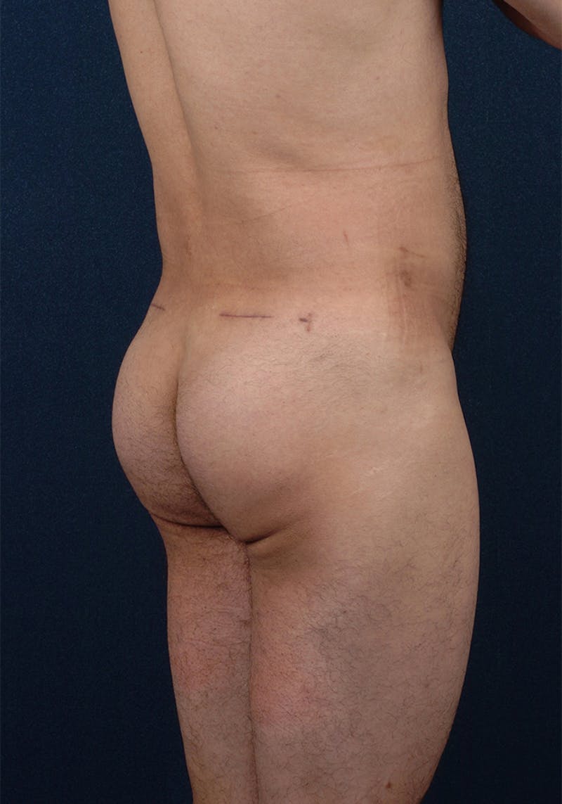 Gluteal Augmentation Before & After Gallery - Patient 9421726 - Image 6