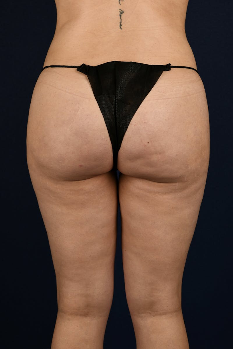 Brazilian Buttock Lift Before & After Gallery - Patient 9421729 - Image 2