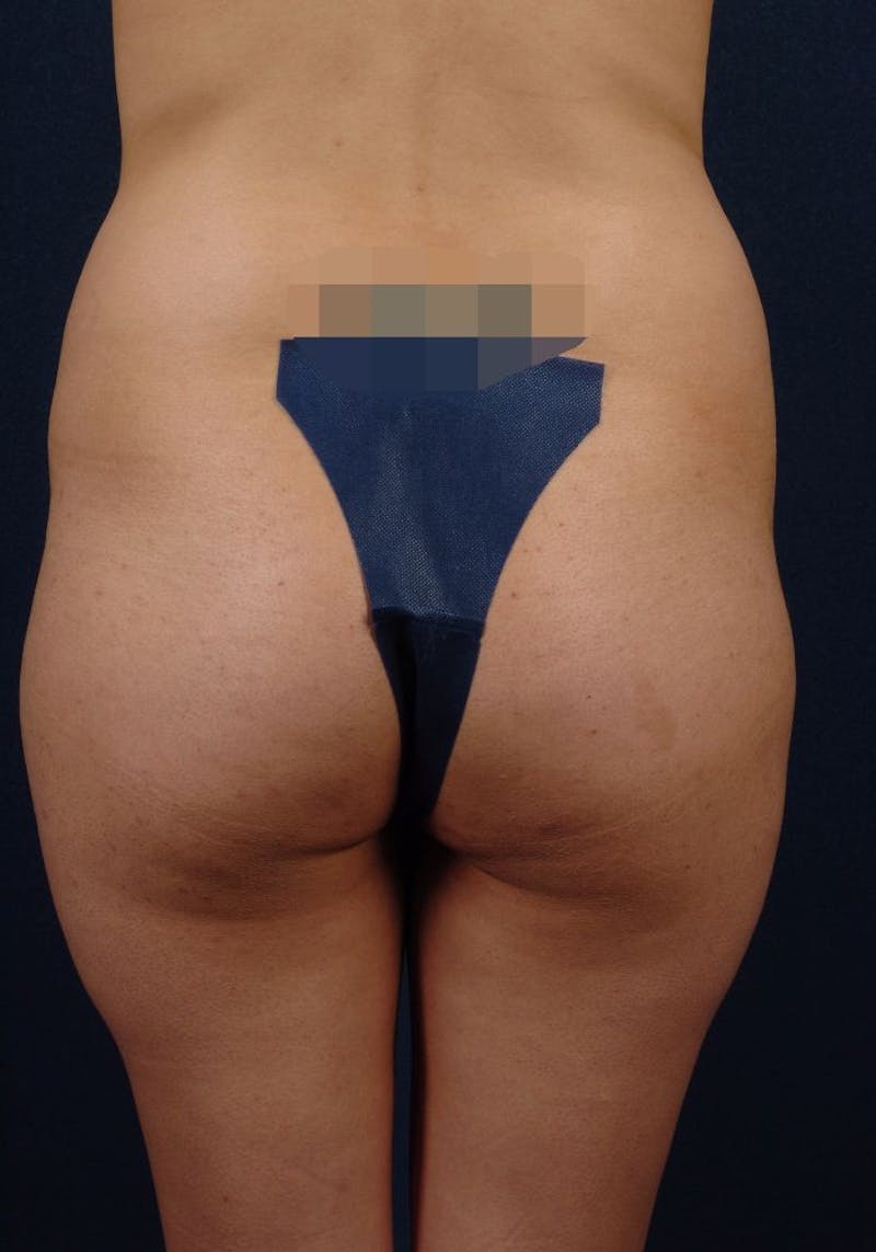 Gluteal Augmentation Before & After Gallery - Patient 9421732 - Image 1