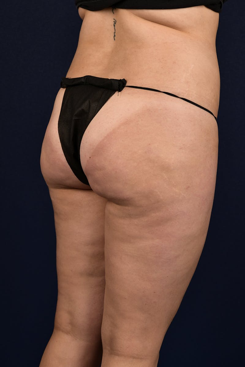 Brazilian Buttock Lift Before & After Gallery - Patient 9421729 - Image 3