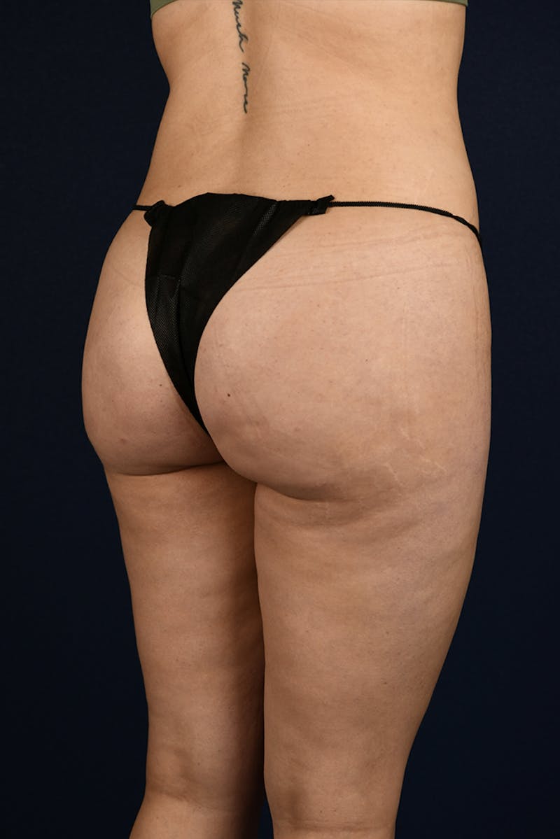 Brazilian Buttock Lift Before & After Gallery - Patient 9421729 - Image 4