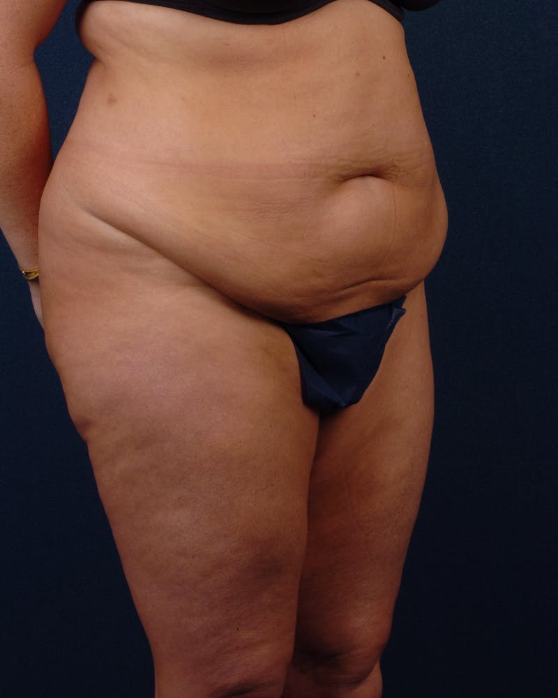 Extreme Body Contouring Before & After Gallery - Patient 9421730 - Image 5