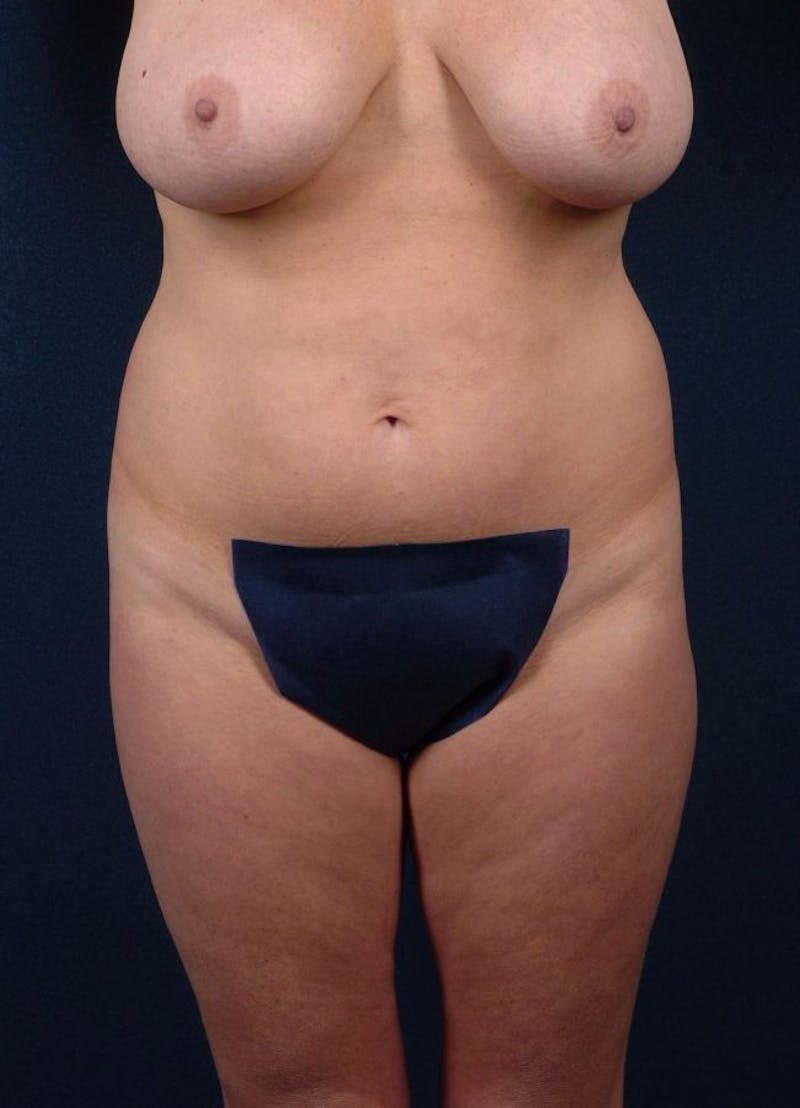 Female Liposuction Before & After Gallery - Patient 9421731 - Image 1