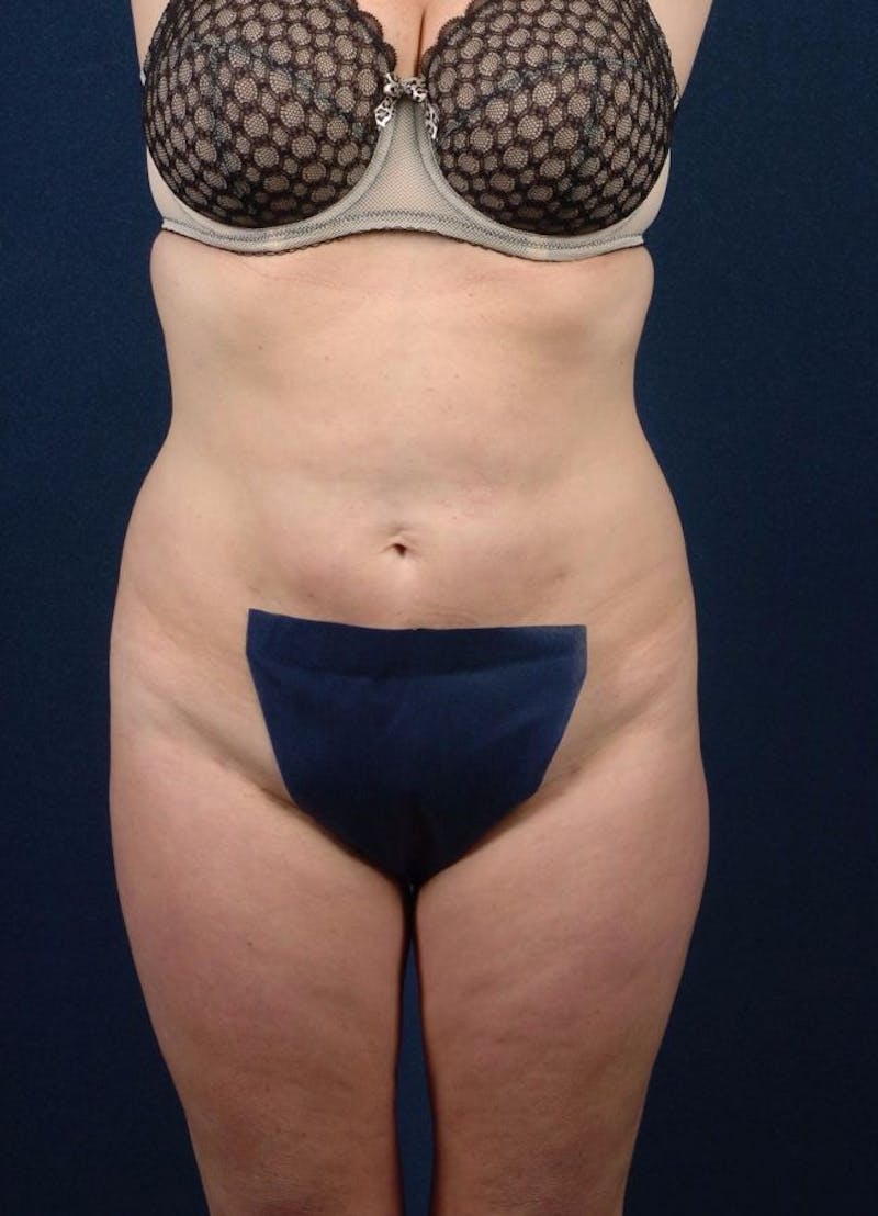 Female Liposuction Before & After Gallery - Patient 9421731 - Image 2