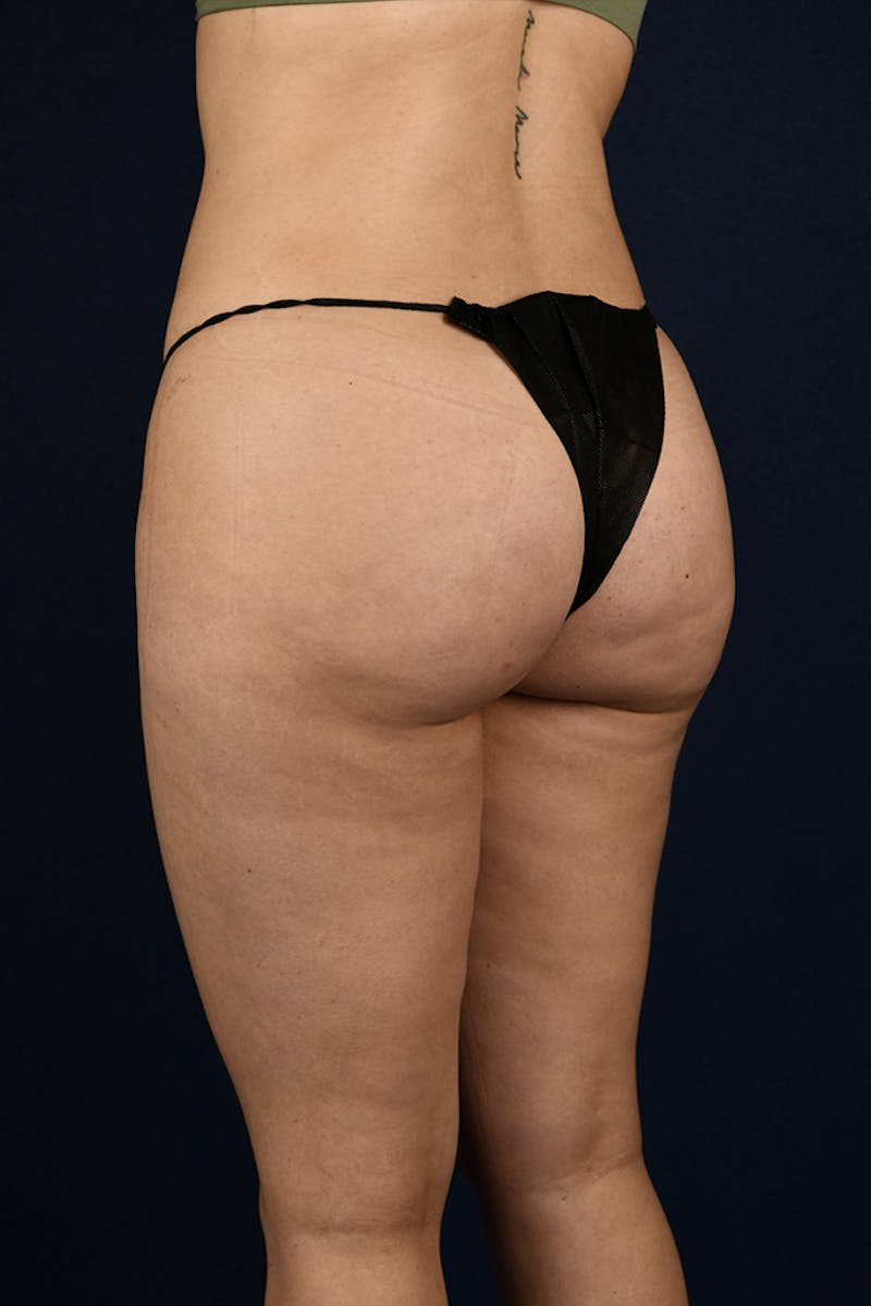 Brazilian Buttock Lift Before & After Gallery - Patient 9421729 - Image 6