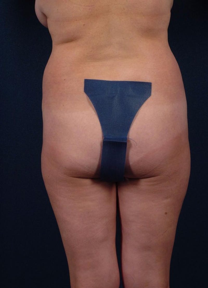 Female Liposuction Before & After Gallery - Patient 9421731 - Image 3