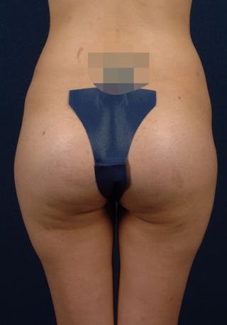 Gluteal Augmentation Before & After Gallery - Patient 9421732 - Image 2
